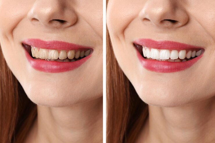 collage-with-photos-woman-before-after-teeth-whitening-closeup