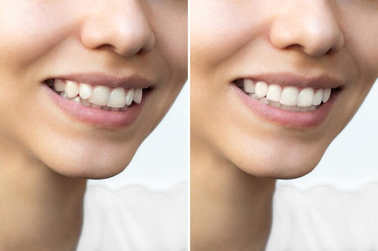 young-woman-s-smile-before-after-teeth-straightening-ideal-beautiful-shape-teeth