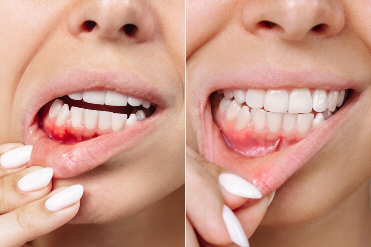 young-woman-with-red-bleeding-gums-health-gums-before-after-treatment-stomatitis-ulcer